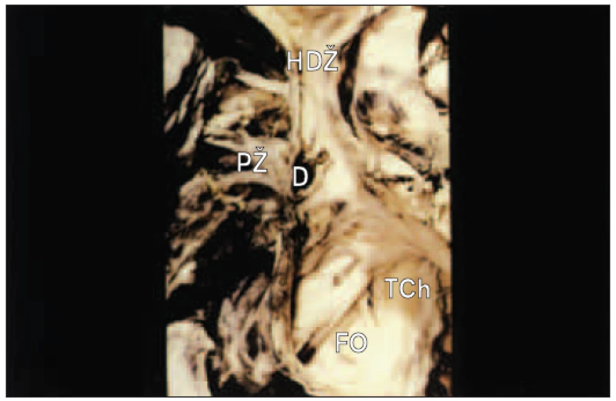 Defekt typu sinus venosus. Defekt je uložen vysoko ve stěně horní duté žíly a pravá plicní žíla vyúsťuje do pravé síně přes defekt.