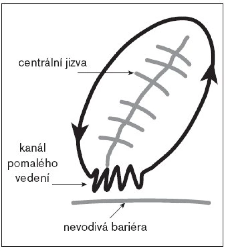 Schéma okruhu reentry okolo centrálně uložené jizvy po atriotomii. Ideálním místem k cílení katetrizační ablace je kanál pomalého vedení mezi jizvou a přilehlou anatomickou bariérou.