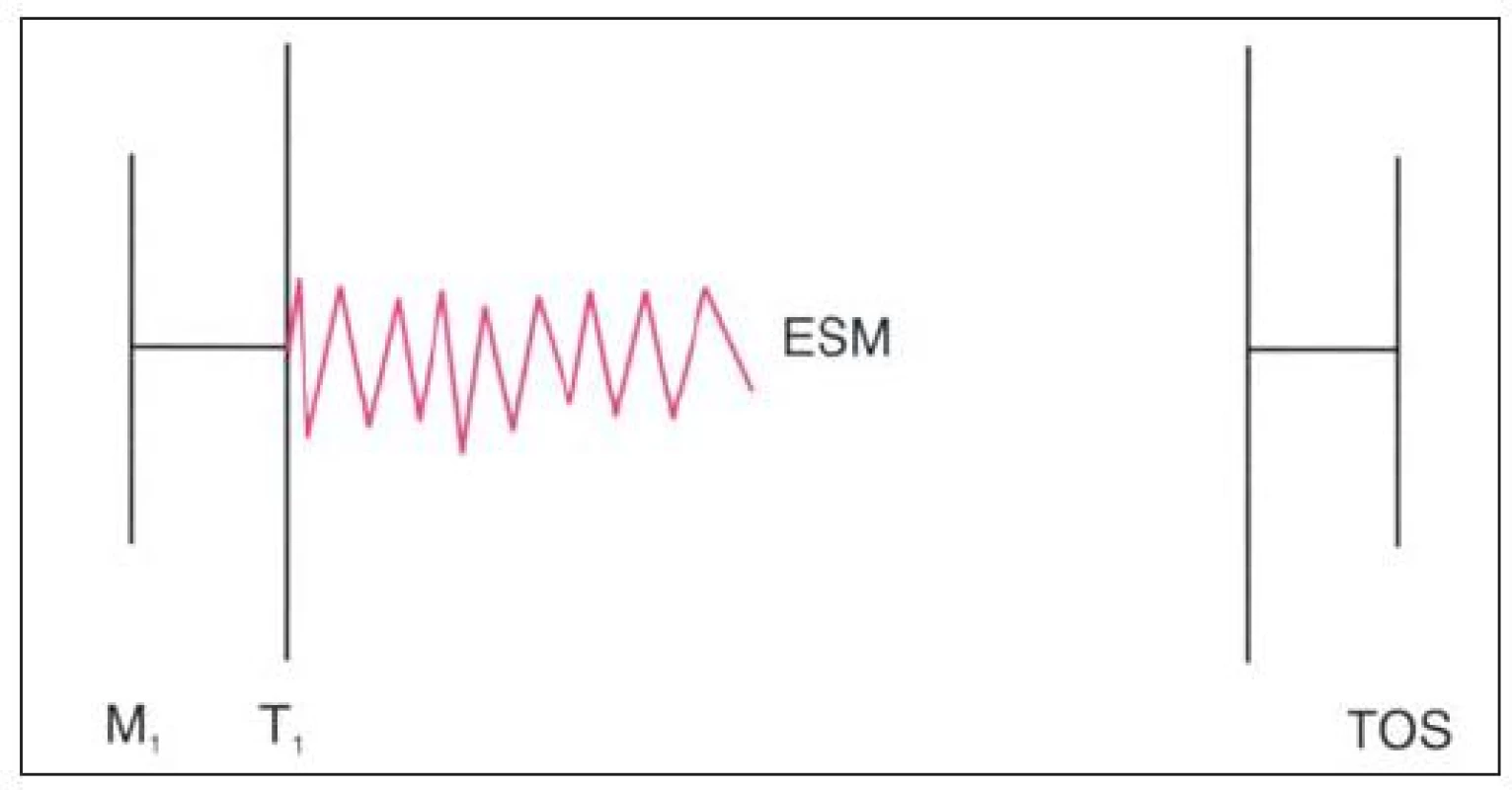 Auskultační nález u Ebsteinovy anomálie komplikované trikuspidální regurgitací. Opožděný zvuk trikuspidálního uzávěru má obvykle „vrzavou“ kvalitu (zvuk plachty).