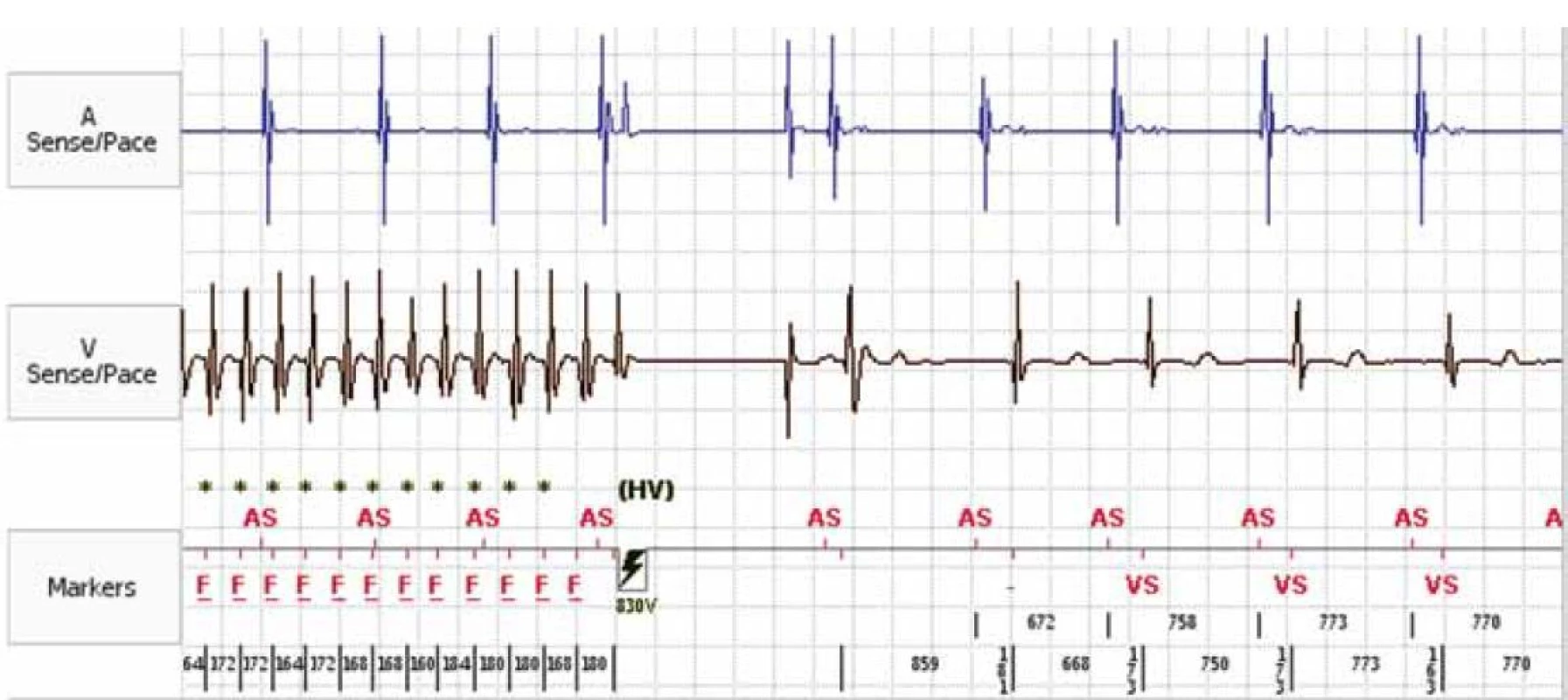 Záznam intrakardiálního EKG z paměti ICD. Epizoda fibrilace komor terminovaná ICD výbojem.