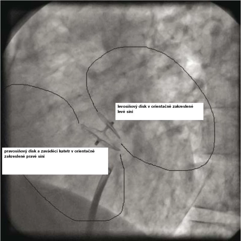 Angiografie – výsledný angiografický obraz uvolněného Amplatzerova PFO okludéru 25 mm.