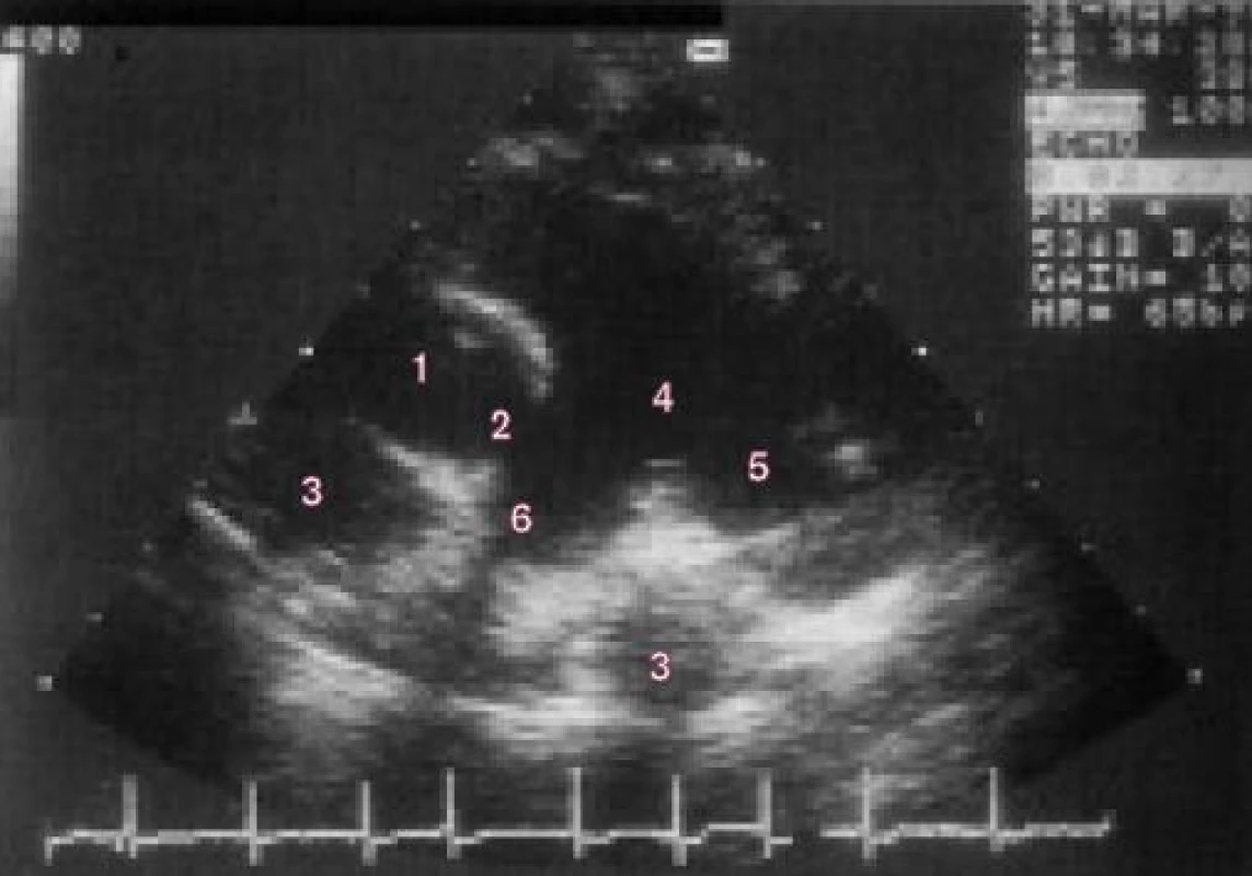 2D-parasternální pohled v krátké ose ukazuje středně ztluštělou pulmonální chlopeň a rozšířené proximální plicní arterie (poststenotickou dilataci) u dítěte se středně těžkou stenózou pulmonální chlopně.