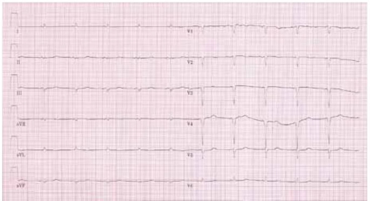 Typický nález „nízké voltáže“ a Q kmitů na EKG u pacienta s AL amyloidózou.