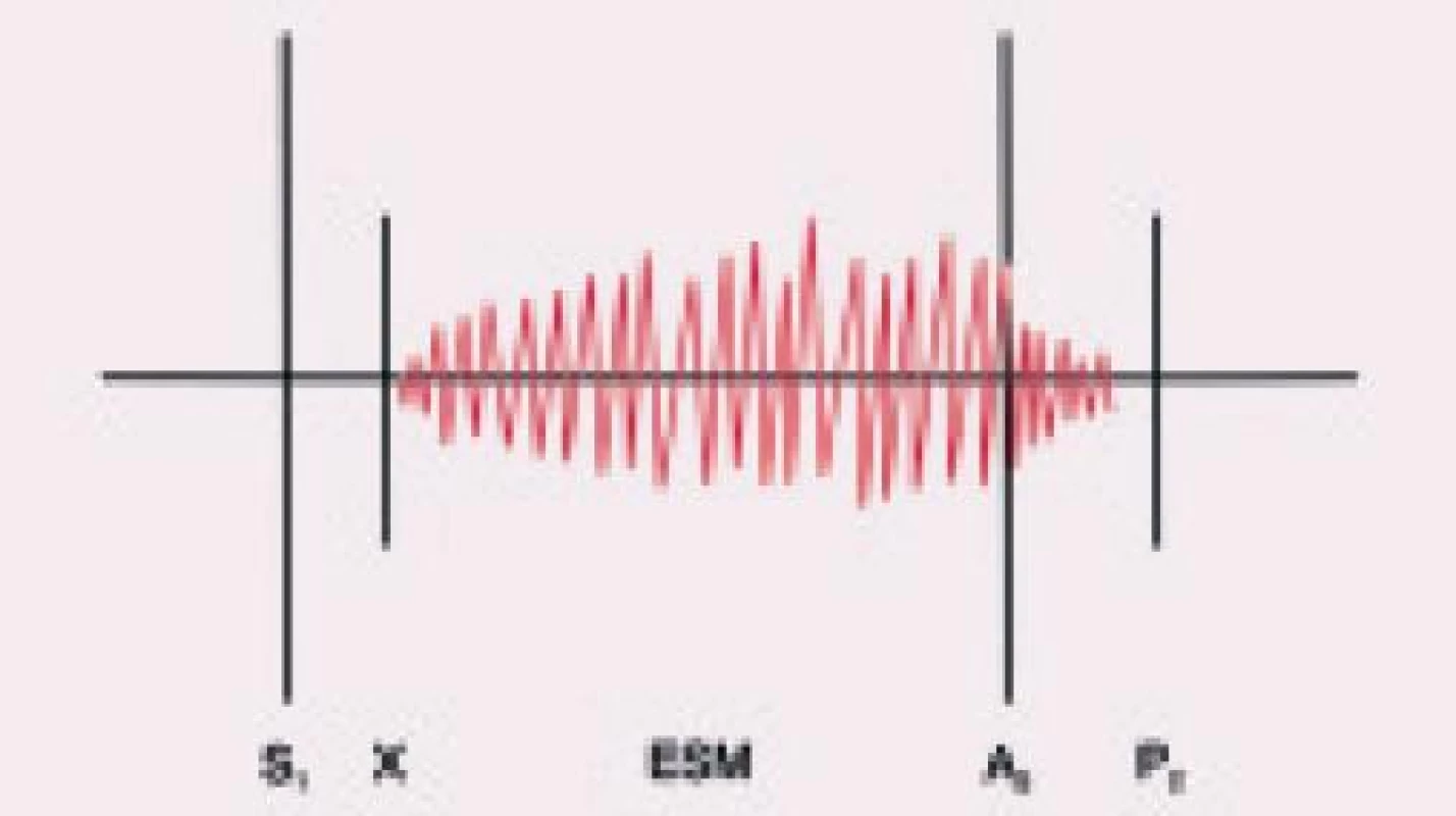 Auskultační nález u stenózy plicnice. Charakteristický je dlouhý ejekční systolický šelest (ESM) často zabírající aortální složku druhé ozvy (A2), nicméně končící před plicní komponentou druhé ozvy (P2). Může být slyšet ejekční klik (X), který má nižší intenzitu během inspiria.