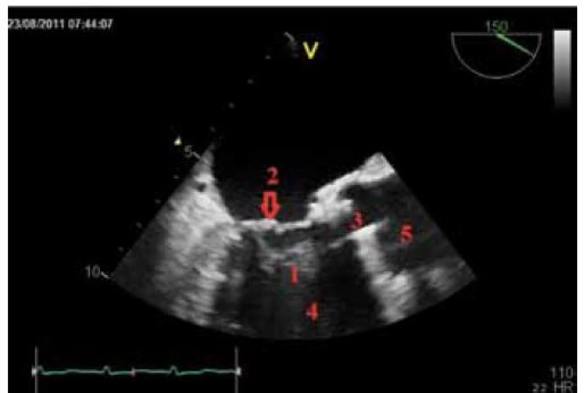 Transesophageální echokardiografie. Echogenní útvar vycházející z mitrální chlopně vlající do LVOT.
1 – akcesorní závěsný aparát mitrální chlopně, 2 – mitrální chlopěň, 3 – otevřená umělá aortální chlopeň, 4 – levá komora, 5 – aorta