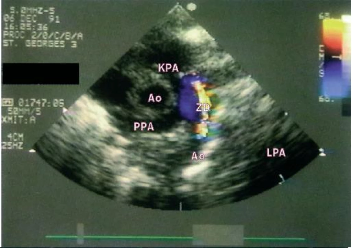 Malá perzistující dučej znázorněná barevným dopplerovským vyšetřením. Turbulentní jet teče z descendentní aorty do plicní arterie.
