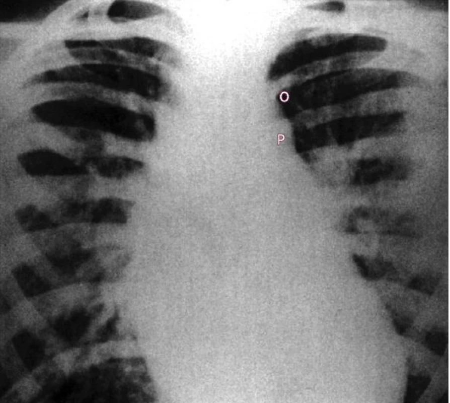 Skiagram pacienta s dučejí a velkým levo-pravým zkratem ukazuje zvětšené srdce a plicní kmen, prominující aortální knoflík a zřetelnou plicní pletoru.