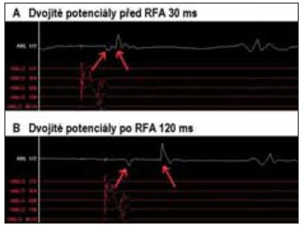 Změny lokálního elektrogramu – disociace dvojitých potenciálů před RFA (A) a po úspěšné RFA (B) mezery v lineární lézi na kavotrikuspidálním istmu.
