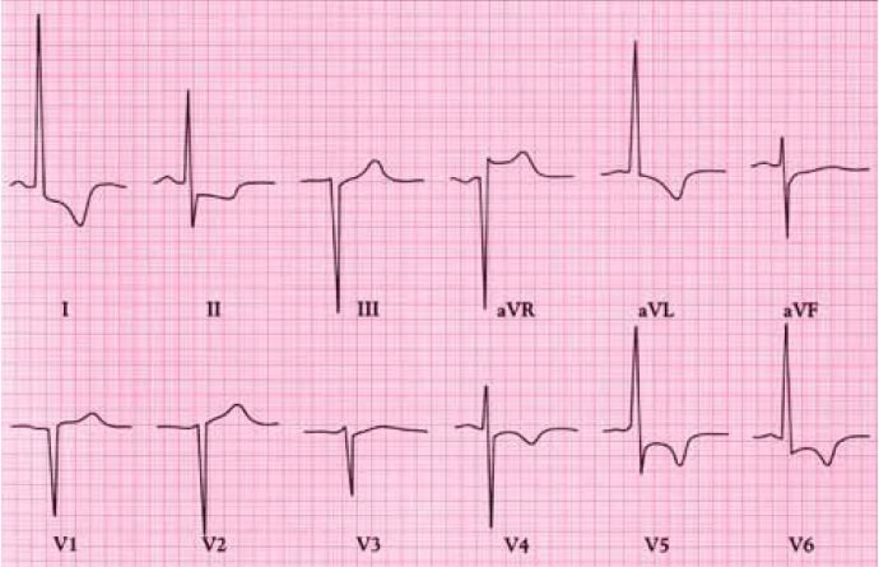 EKG u pacienta s koarktací aorty. Vysoké voltáže komplexů QRS a změny ST-T ve svodech I, II, aVL a V4-6 značí hypertrofii levé komory. NB: 1mV ve V4-6 = 0,5 cm