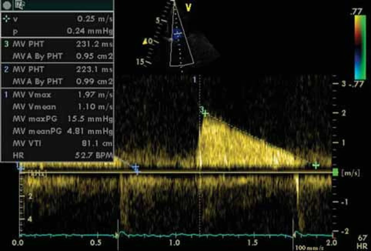 Doplerovská echokardiografie u mitrální stenózy. Výpočet středního gradientu (meanPG) a MVA dle PHT.