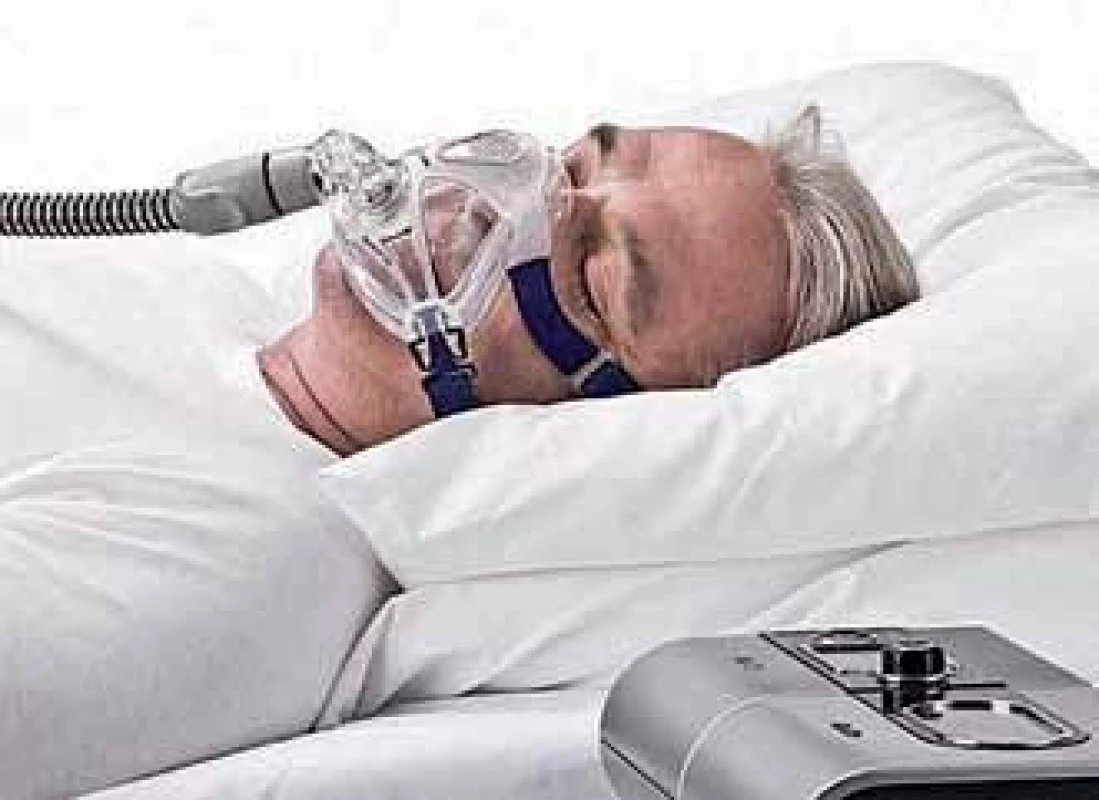 Léčba obstrukční spánkové apnoe pomocí trvalého přetlaku v dýchacích cestách.