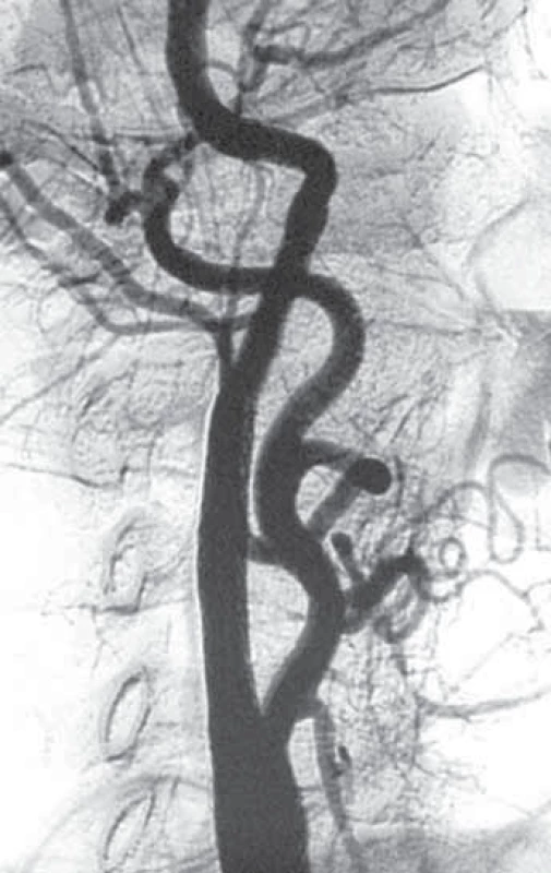 Angiogram původně stenotické karotické tepny po implantaci stentu.