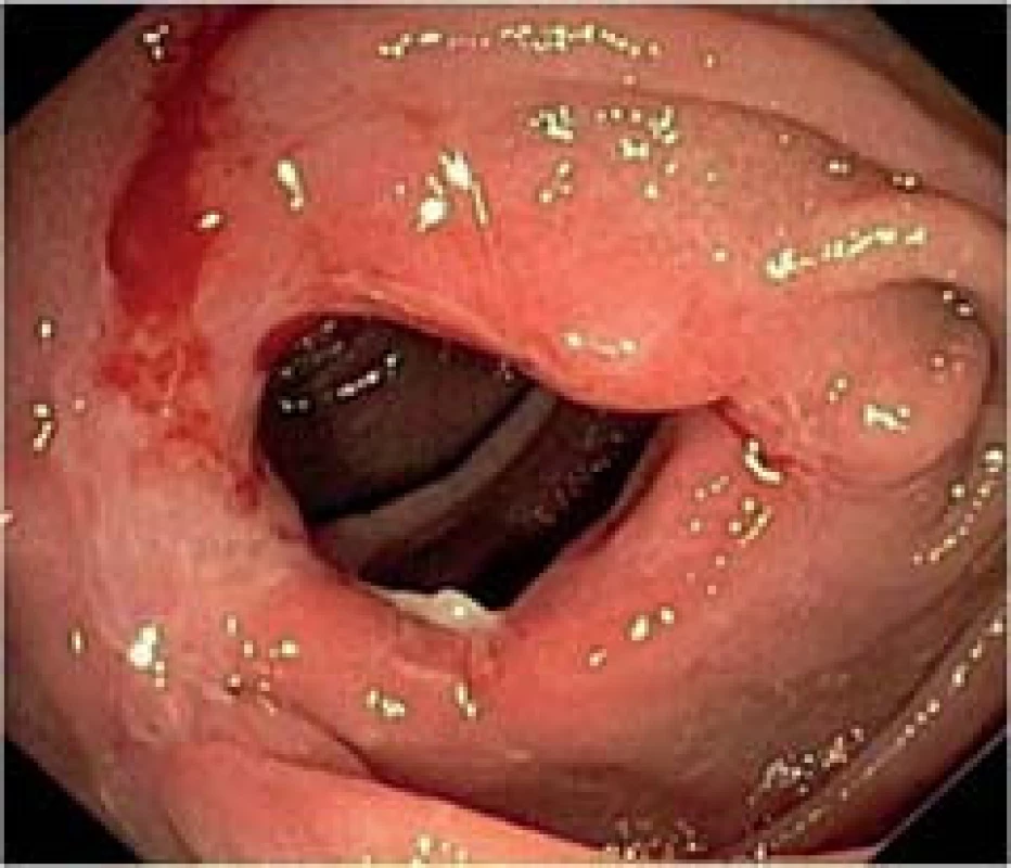 Endoskopická balonová dilatace stenotické anastomózy u nemocného s Crohnovou chorobou. A – stenóza před dilatací. B – dilatační balon zavedený do stenózy. C – lumen střeva po dilataci.