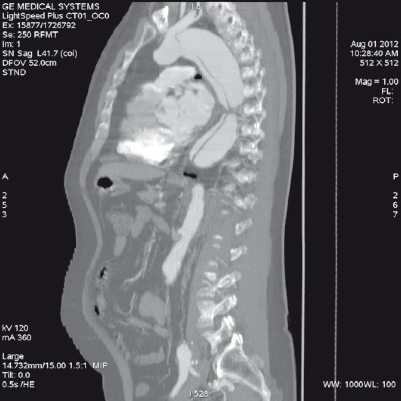 Spirální CT angiografie se zobrazením širokého primárního entry tear a jeho vztahu k levé podklíčkové tepně.