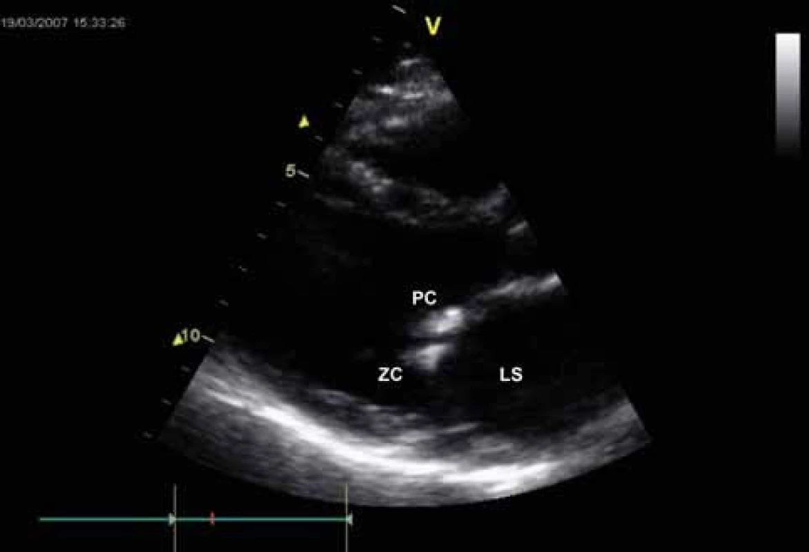 Echokardiografie u mitrální stenózy – B mode zobrazení, dlouhá osa parasternálně. Revmatické ztluštění cípů mitrální chlopně. 