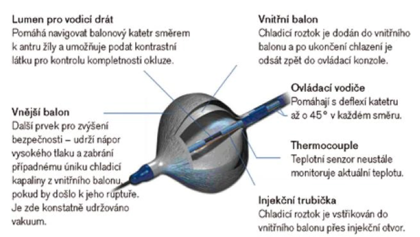 Kryoablace fibrilace síní balonovým katetrem Arctic Front (Medtronic). Balonový katetr se zavede proti antru plicní žíly tak, že plně obturuje její ústí, poté se napustí chladicím roztokem a dojde k hlubokému promražení tkáně. Pokud je balonek v kontaktu s tkání po celé cirkumferenci plicní žíly, což je někdy svízelné, dojde k její elektrické izolaci jedinou takovou aplikací trvající cca 300 s.
