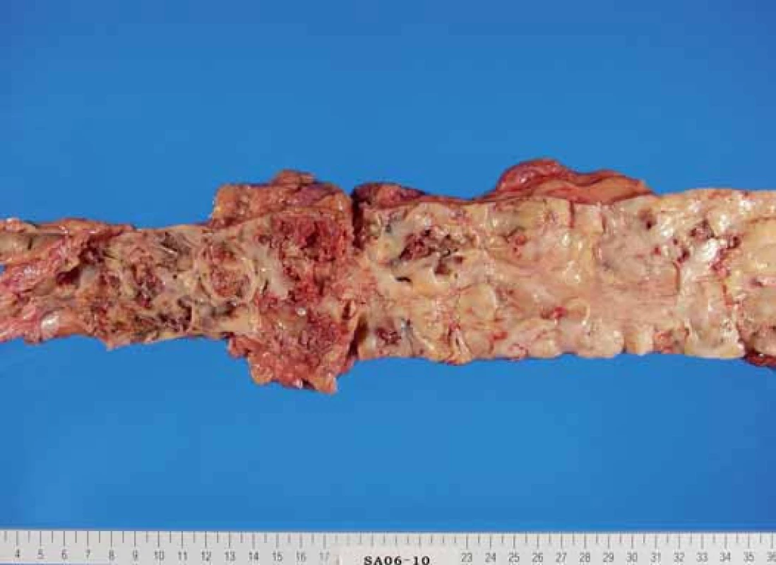 Morfologický obraz (post mortem) vnitřní plochy aorty u dvou pacientů. Publikováno se souhlasem autora [18].