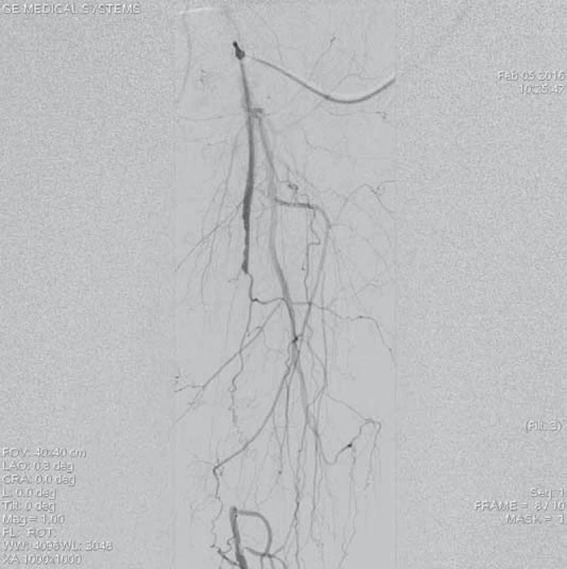 Angiografie aterotrombotického uzávěru střední části levé povrchní stehenní tepny.