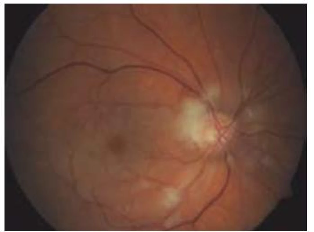 Oční pozadí – týž pacient. Progrese ischemie, úplná okluze retinální arterie, cca 96 hod od vzniku prvních obtíží („třešňová“ makula).