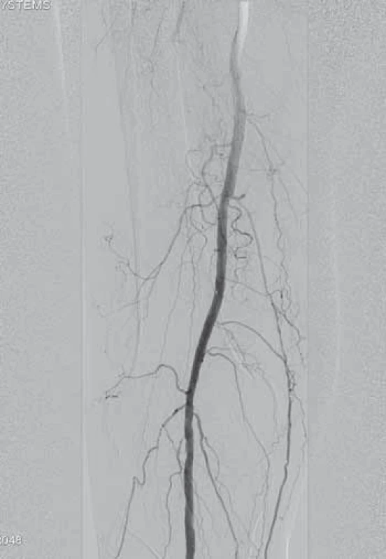 -8. Zrekanalizovaná popliteální arterie po DCB PTA a zrekanalizované ATA (arteria tibialis anterior), TTF trunku (trunkus tibiofibularis) se stenty.