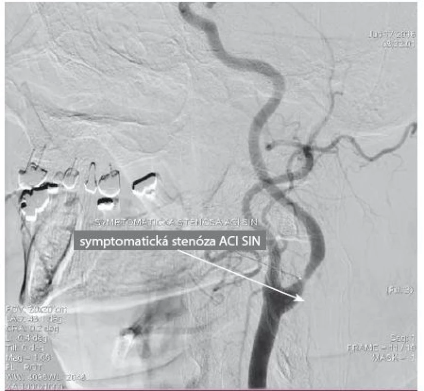 DSA angiografie. Perioperační angiografie znázorňující těsnou stenózu ACI vlevo.