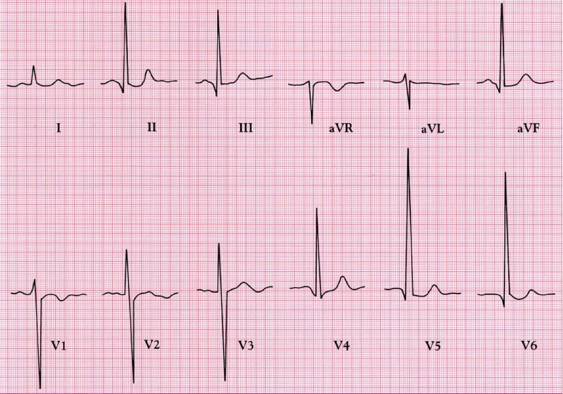 EKG ukazuje vysoké kmity R nad levou komorou a hluboké kmity S v protilehlých svodech – obraz diastolického přetížení.