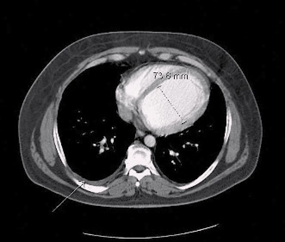 CT hrudníku z roku 2013 – na transverzálním řezu v měkkotkáňovém okně sledovatelná dilatace levé komory a pleurální výpotek vpravo (šipky).