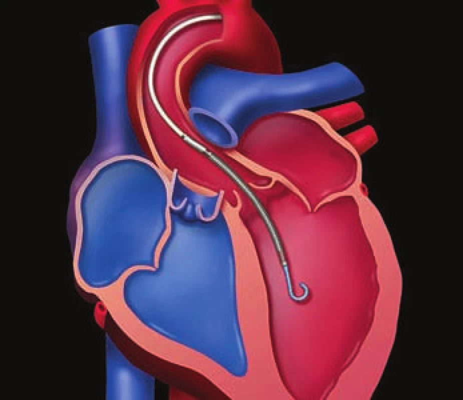 Systém Impella 2.5. Mikroaxiálna
pumpa je uložená cez aortálnu chlopňu
a prečerpáva krv z dutiny ľavej komory do
aorty.