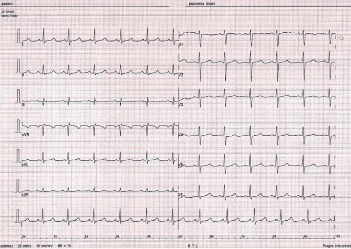 12svodové EKG po úspěšně provedené ablaci FAT u stejného pacienta.