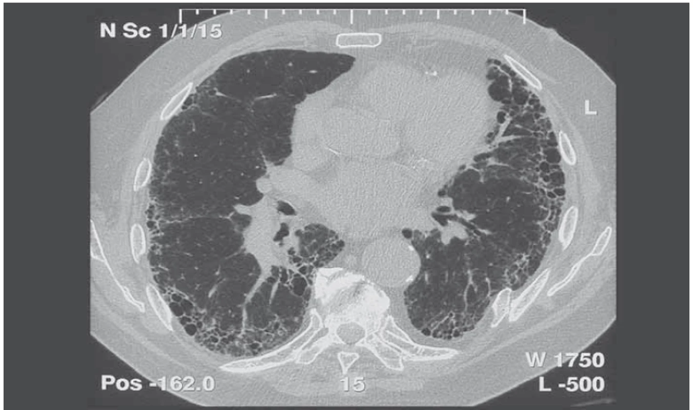 HRCT obraz (CT hrudníku s vysokou rozlišovací schopností) idiopatické plicní fibrózy.