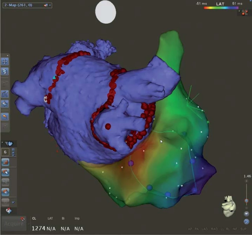 CARTO 3 mapa levé a pravé síně u téhož pacienta s fokální síňovou tachykardií z pravé dolní plicní žíly a paroxysmy fi brilace síní.