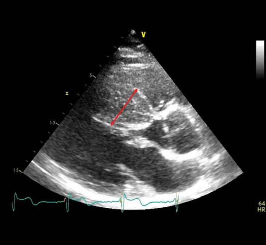 Echokardiografický obraz hypertrofické kardiomyopatie se
zesílením mezikomorového septa na 40 mm. Zdroj: Archiv autora.