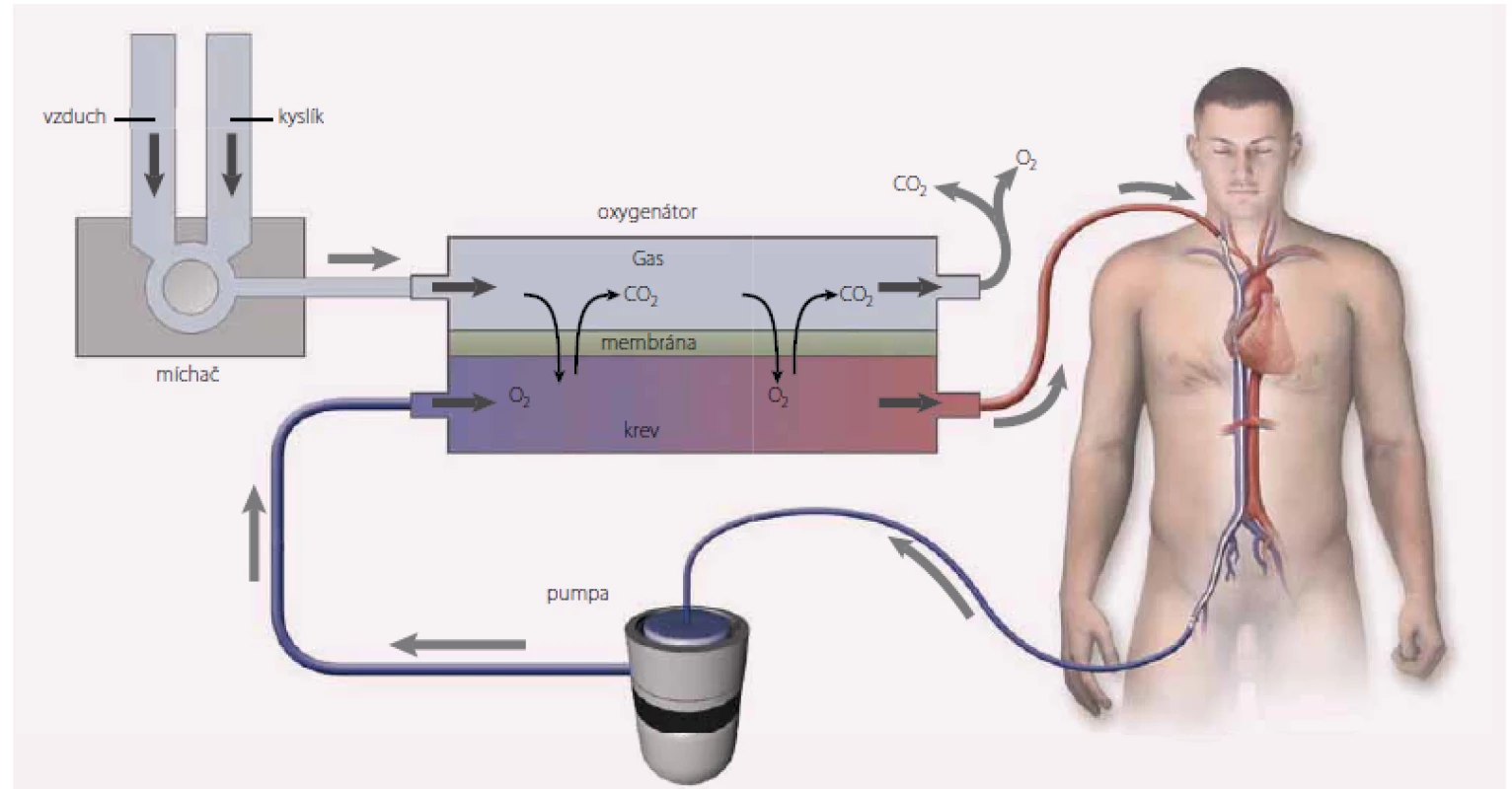 Schéma veno-arteriální mimotělní membránové oxygenace (V-A ECMO). Převzato z [4].