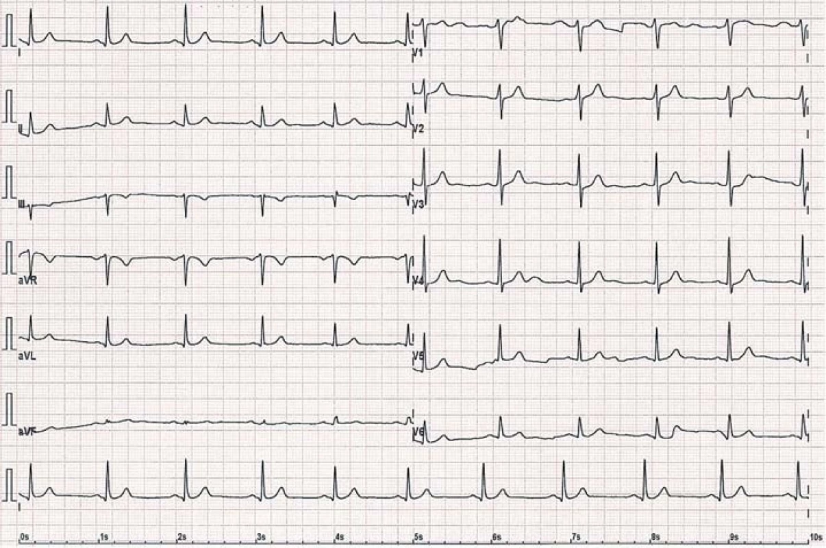 12svodové EKG u téhož pacienta po úspěšné radiofrekvenční ablaci přídatné dráhy s vymizením známek preexcitace.