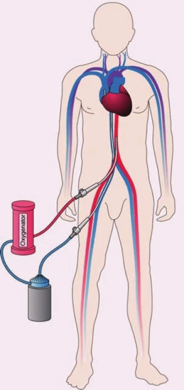 Extrakorporálna membránová oxygenácia.
Venózna krv sa odsáva z pravej
predsiene, prechádza oxygenátorom a prečerpáva
sa do arteriálneho systému. Systém
prakticky nahrádza funkciu srdca aj pľúc.
Z kardiologického hľadiska ide o biventrikulárnu
podporu.