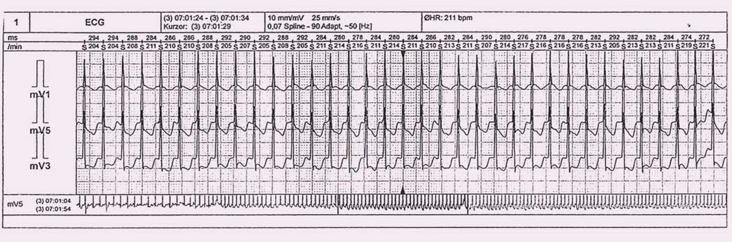 Holterova EKG monitorace se záchytem paroxysmu typické AVNRT.