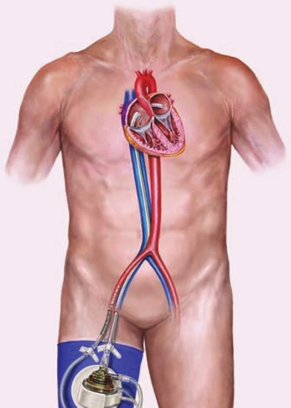 Perkutánny podporný obehový
systém TandemHeart. Okysličenú krv odčerpáva
pumpa cez kanylu umiestnenú do
ľavej predsiene do descendentnej aorty.
Tým sa odľahčuje ľavá komora a nahrádza
sa jej činnosť [29].
