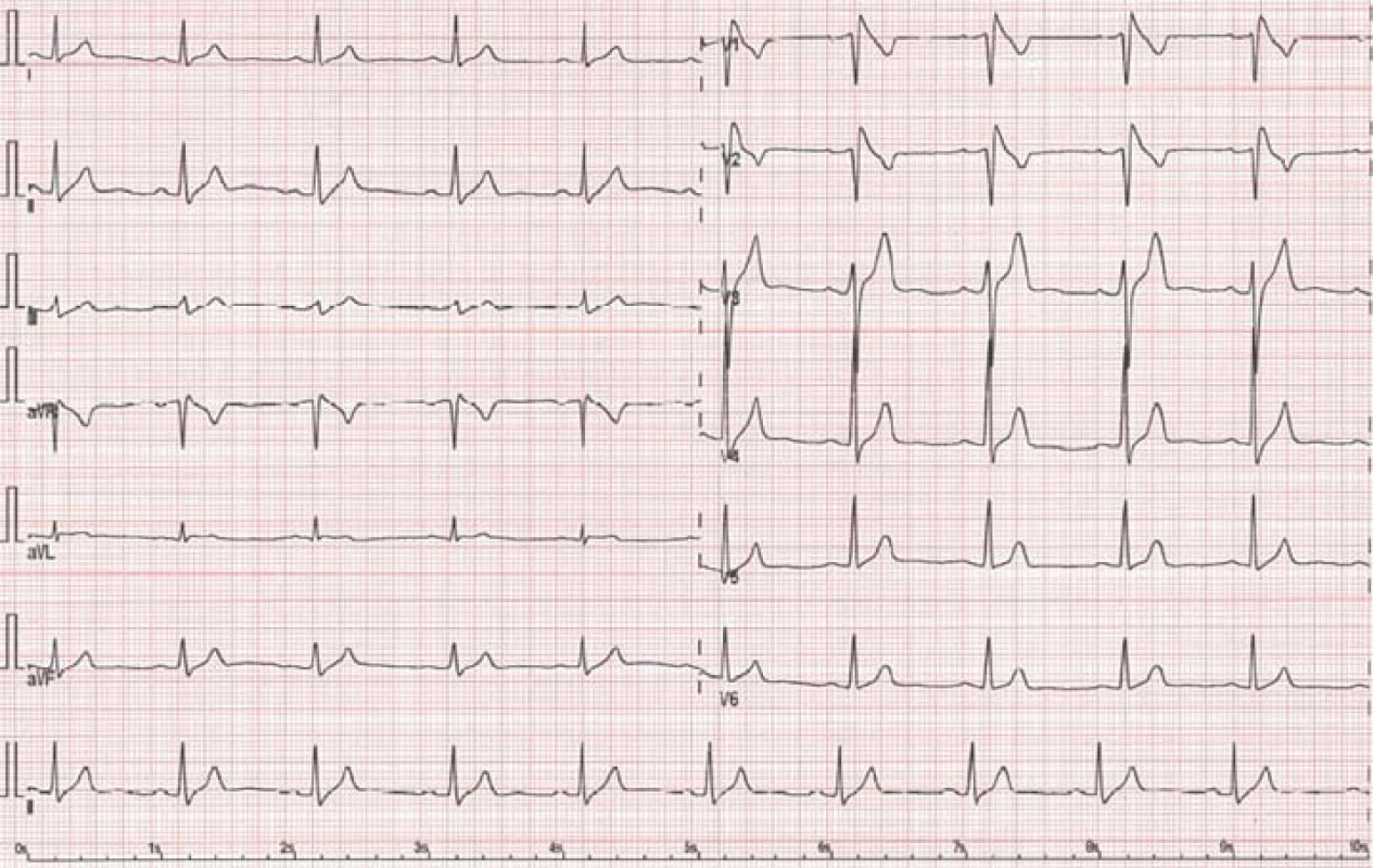 EKG obraz Brugadova syndromu – typ I („coved type“) s nahoru vyklenutou ST elevací.